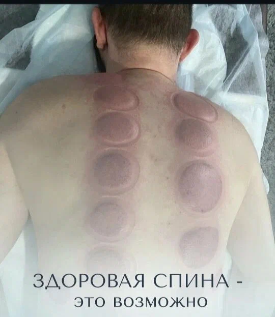 Следы после баночной техники на спине